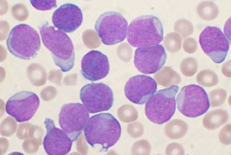 acute lymphoblastic leukemia