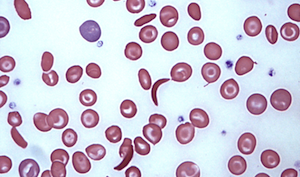 sickled red blood cells