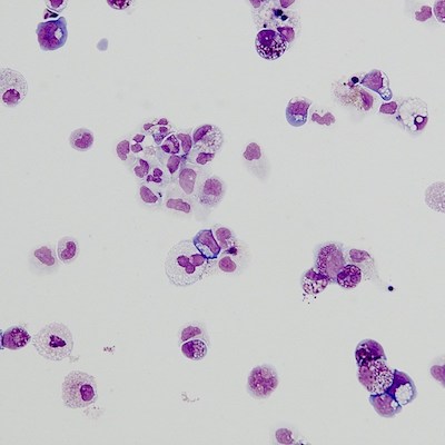Red blood cells made via iPS cells from a Diamond-Blackfan anemia patient.