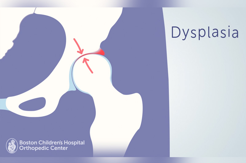 Illustration of hip dysplasia showing how improper coverage of the femoral head can put stress on the labrum and lead to a labral tear.