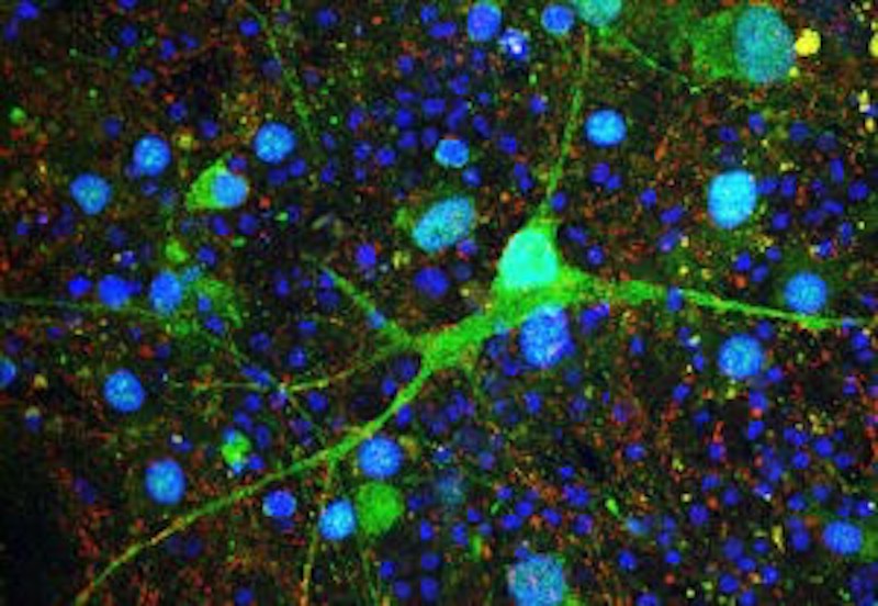 A Purkinje cell made from a patient with tuberous sclerosis complex