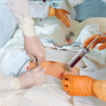 bone marrow transplant operation