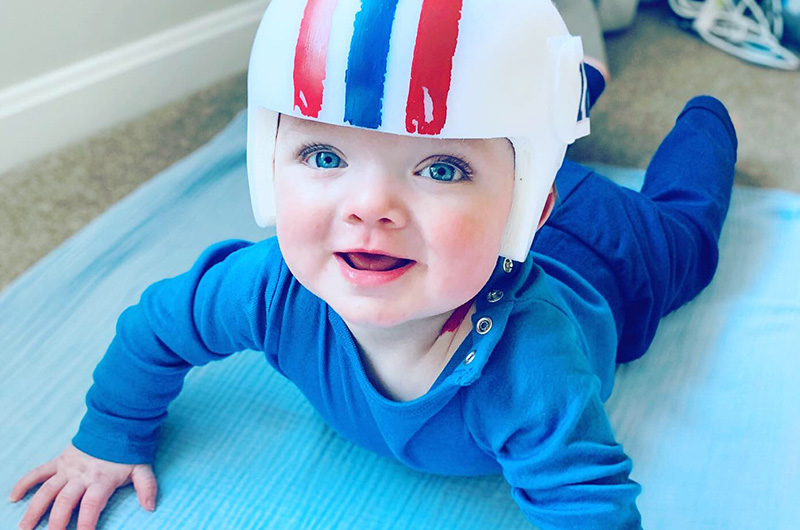 baby with reflux wearing a helmet 