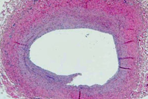 A closeup of a vein affected by pulmonary vein stenosis