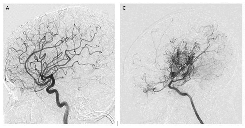 X-rays contrast normal blood vessels of the brain with the many smaller vessels that form in moyamoya patients