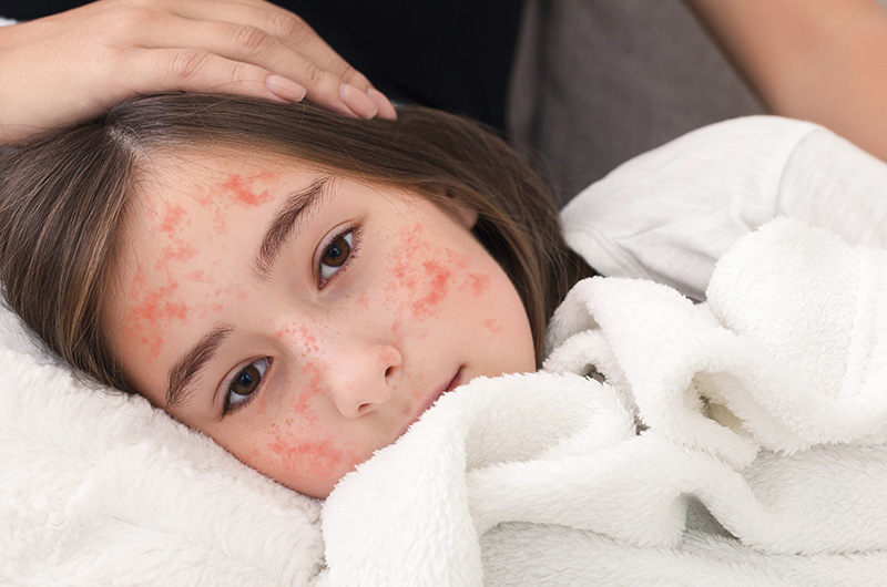 Girl with measles on her face lies in bed