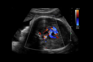 MRI showing VOGM