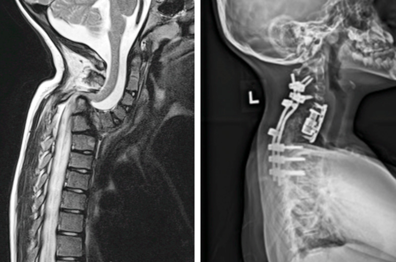 Radiological images of cervical spine before and after surgery. 