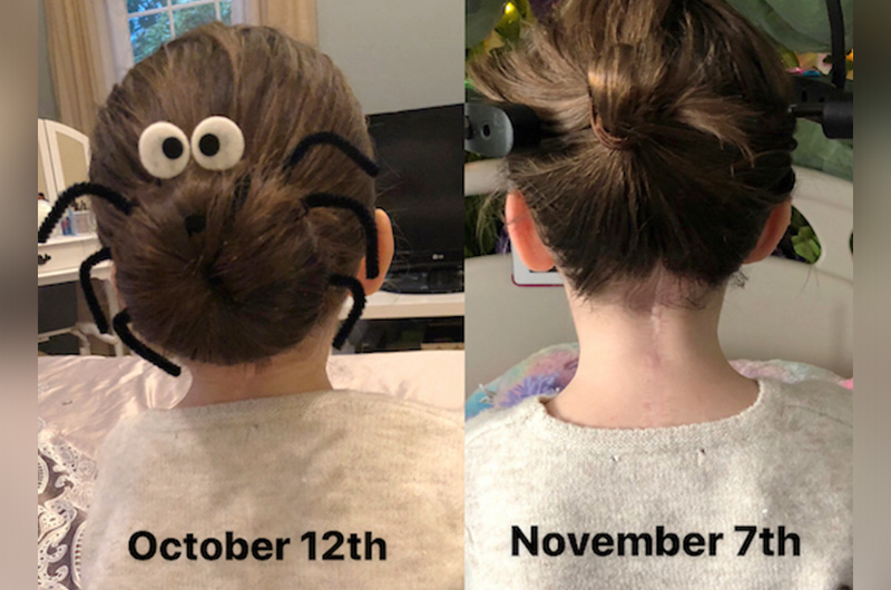A view of Gracie's neck before and after halo traction, before spinal fusion surgery.