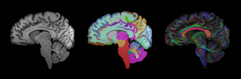 brain images developmental synaptopathies