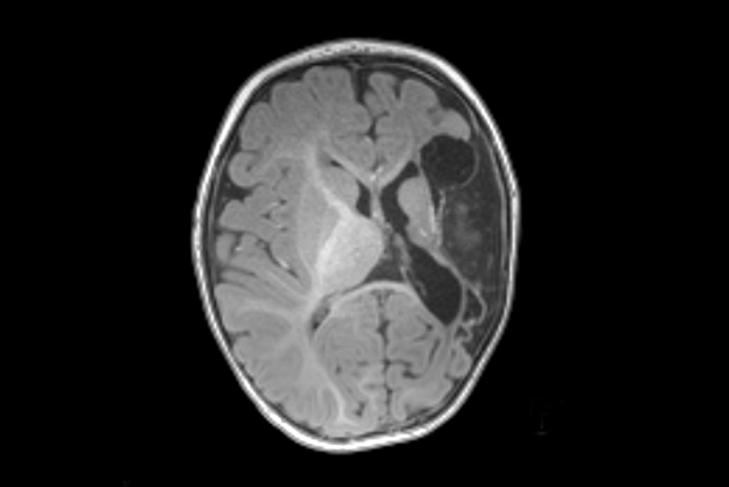 mri scan of simon's brain after pediatric stroke