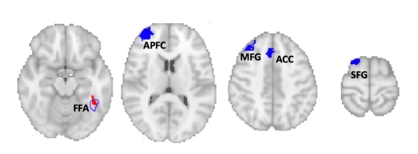 Brain areas negatively correlated with prosopagnosia lesions