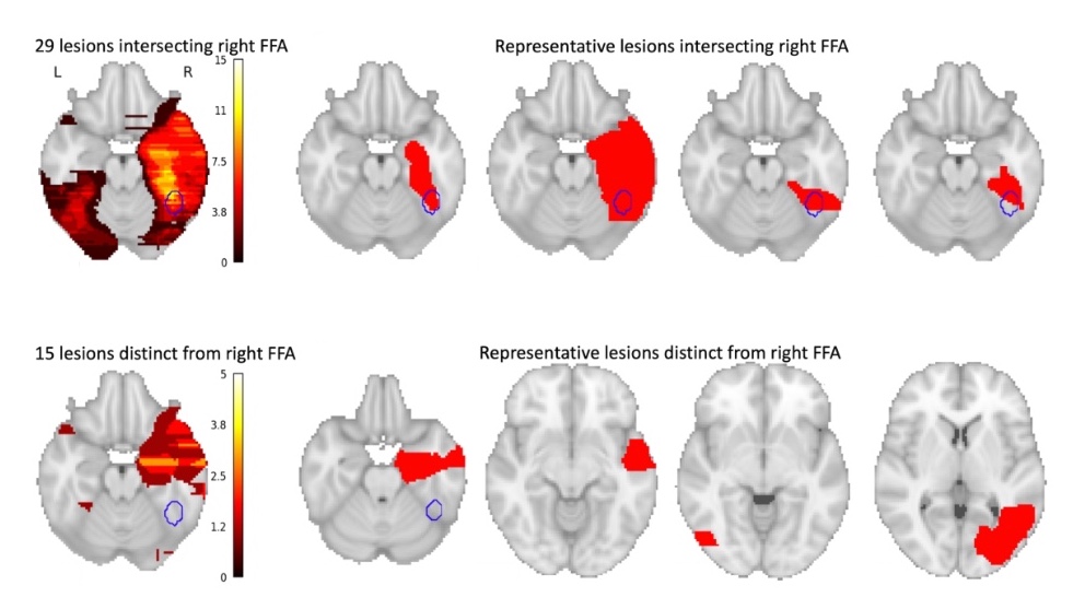 brain areas associated with face blindness or prosopagnosia