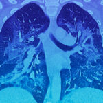CT scan of the lungs of a vaping patient.