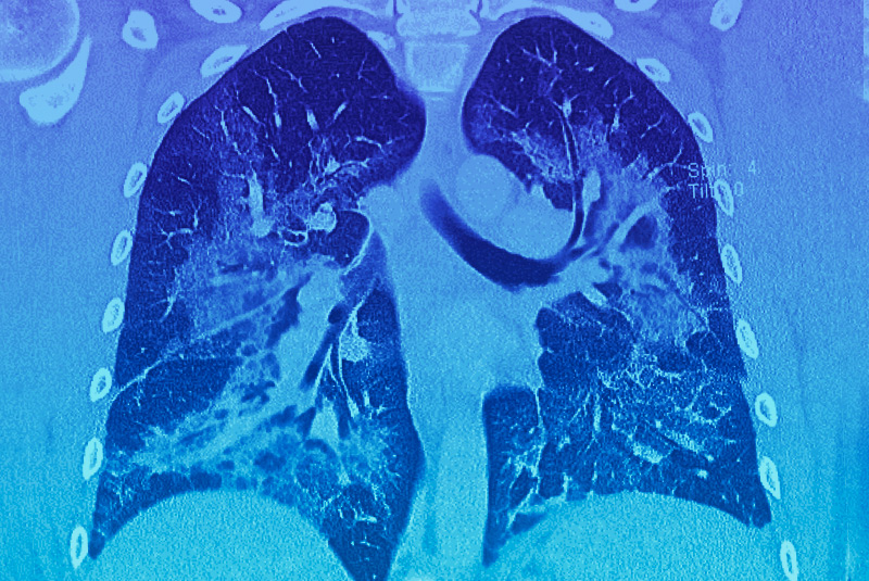 CT scan of the lungs of a vaping patient.