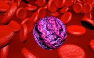 acute myeloid leukemia AML