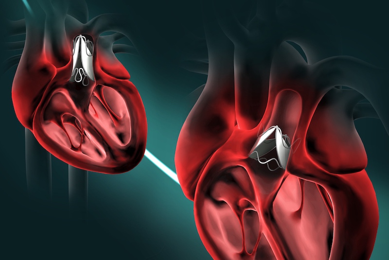 bileaflet heart valve expanding to accommodate a growing heart