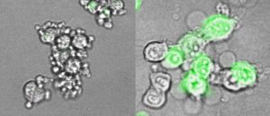 cancer immunotherapy: cancer cells with and without gasdermin E