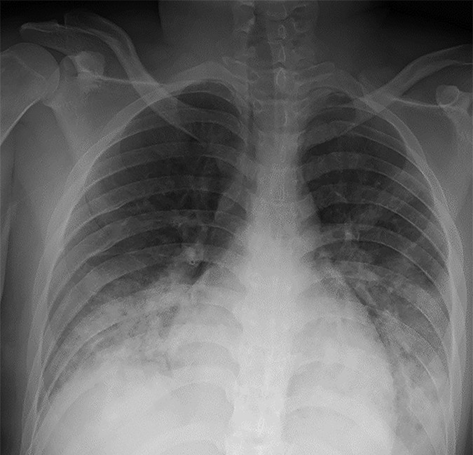 Chest X ray of child with COVID-19
