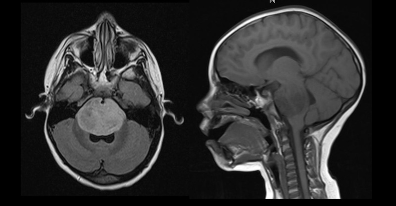 assessing pediatric glioma