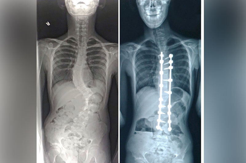 In an x-ray taken before surgery, Jared's mid and lower spine had a severe side-to-side curve. An x-ray taken after spinal fusion surgery shows the rods and screws holding his spine in an upright position. 
