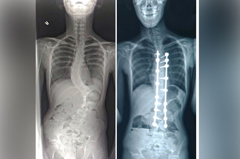 Spinal fusion surgery during COVID19 Boston Children's