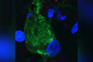 tuberous sclerosis giant cell