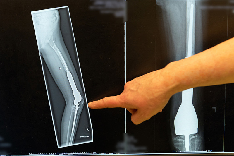 An x-ray image of an extendable prosthesis that has been used to replace a section of bone with bone cancer. 