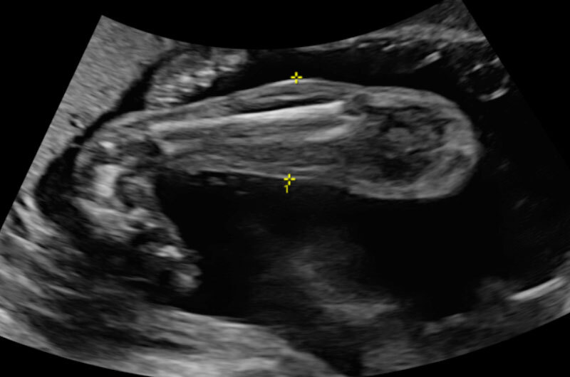 An ultrasound image of suspected clubfoot. 
