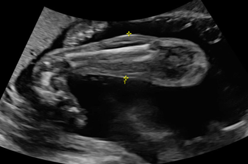 When Your Baby Has Clubfoot Answers For Expecting Parents Boston Children S Answers