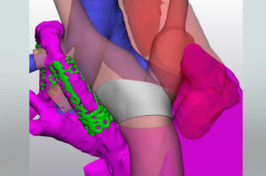 Position of designed cuff between the 20mm conduit and the PA branches with 38mm diameter including extension into RPA
