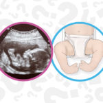 ultrasound image and clubfoot illustration. The feet are angled inward and upward.