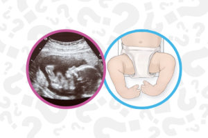 ultrasound image and clubfoot illustration. The feet are angled inward and upward.