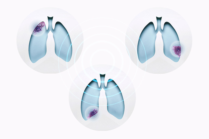 lung cancer organoids