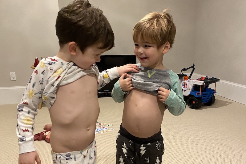 Evan and West, who both had heart surgery, compare their scars.