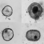 Normal intestinal organoids in contrast to intestinal organoids derived from patients (right) with a newly-discovered gene mutation linked to congenital diarrhea.