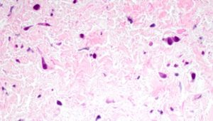 Magnification of pulmonary vein tissue showing signs of pulmonary vein stenosis (