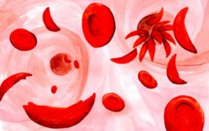 Sickled cells occluding a blood vessel. (