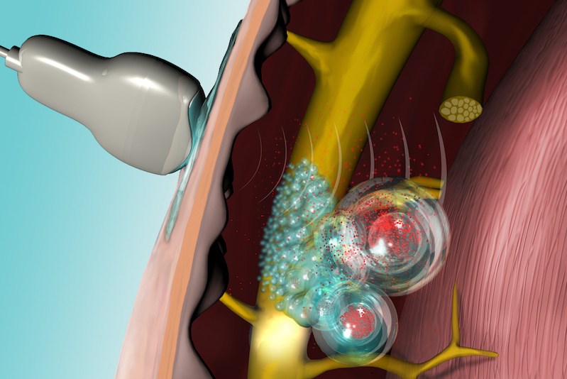 Ultrasound triggers the release of local anesthetics from injectable liposomes.