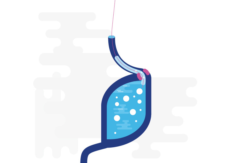 an illustration of a stomach with a "FLIP" device in it
