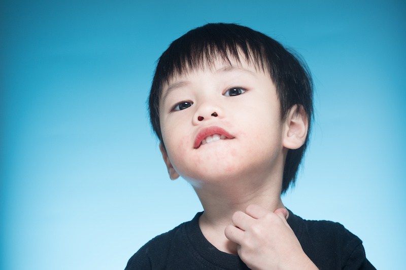 Child with eczema
