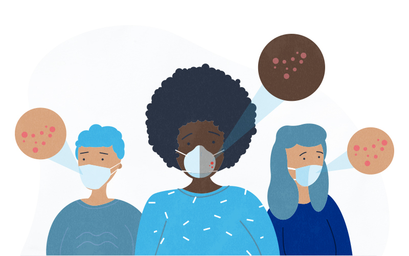 an illustration of people wearing masks and developing acne