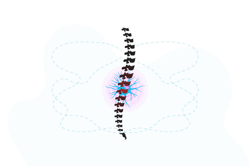 illustration of spinal cord with nerve injury