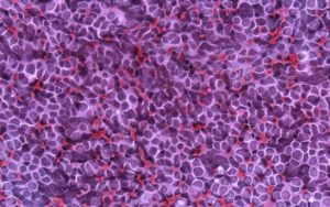medulloblastoma in a child