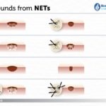 wounds and neutrophil extracellular traps (NETs)