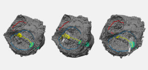 Three side-by-side 3D images of a heart, with conduction tissue in green