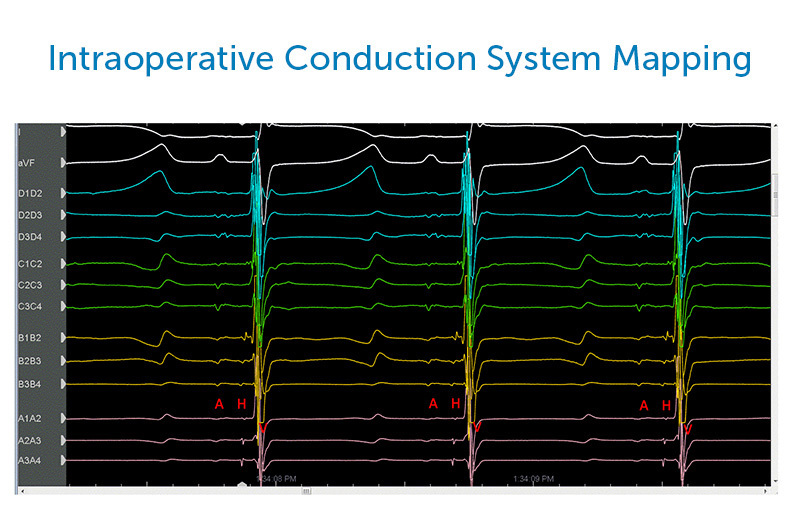 Intracardiac electrogram recordings using the Abbott Advisor HD Grid catheter (Abbott Cardiovascular, Chicago IL). His bundle electrogram noted on multiple bipoles, most prominent on A2A3, A3A4 with bundle potential on B1B2.