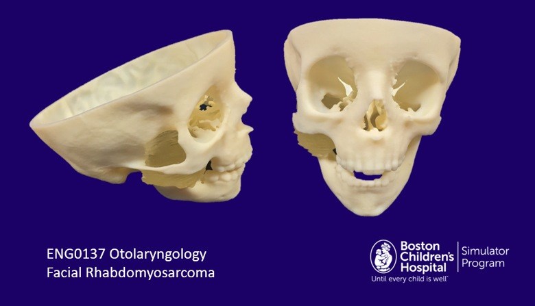 Model of a facial rhabdomyosarcoma - SIMPeds