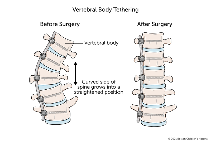 A before and after illustration of vertebral body tethering for scoliosis. Before the surgery, several vertebrae are shorter on one side than the other. After surgery to attach the tether to the curved side of the spine, the vertebrae grow into even shapes and the spine becomes straighter.