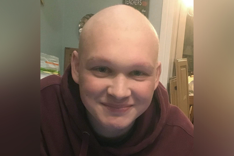 liam with his head shaved after treatment for liver cancer